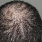 Rear view of the crown of the head with hair loss problems