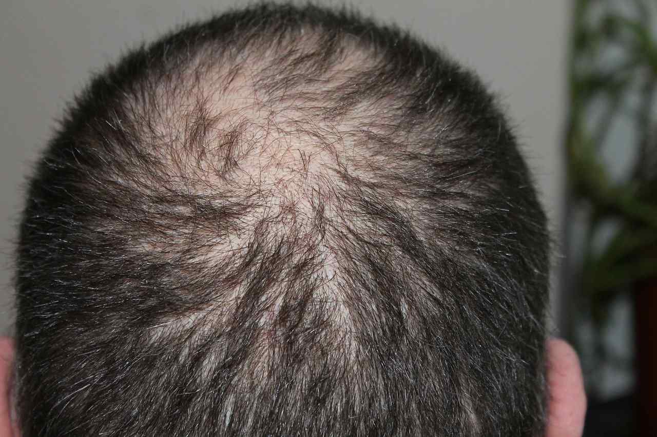 Rear view of the crown of the head with hair loss problems