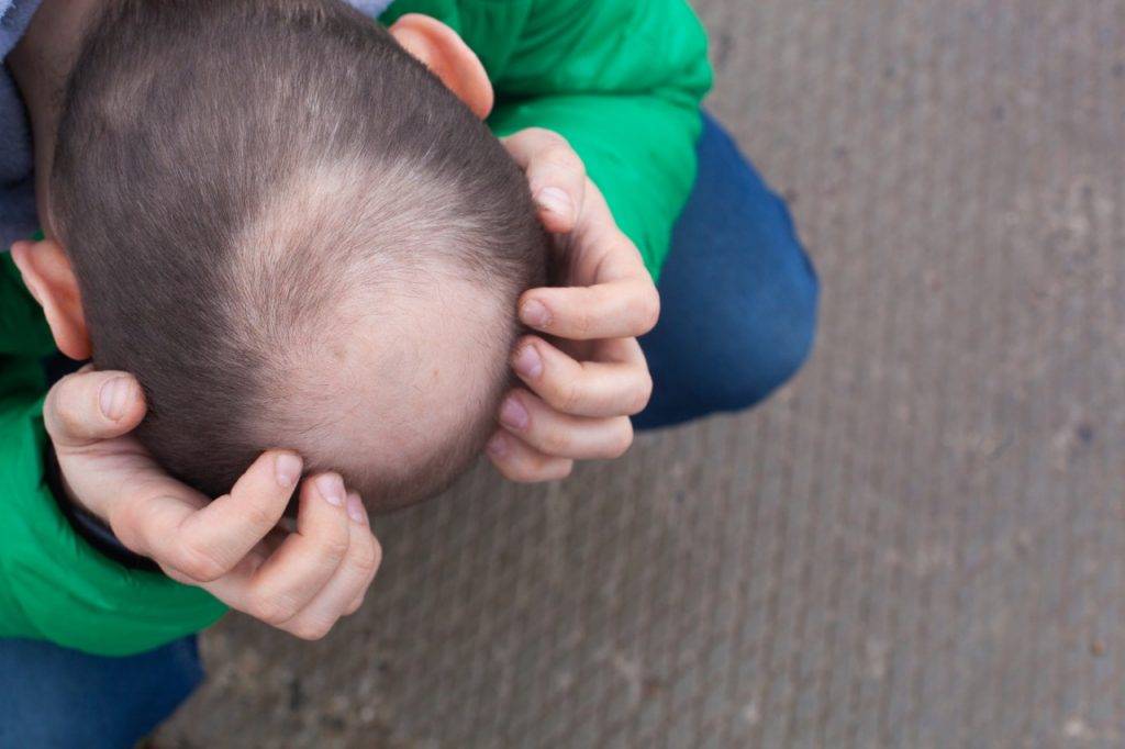 Trapianto di capelli a corona