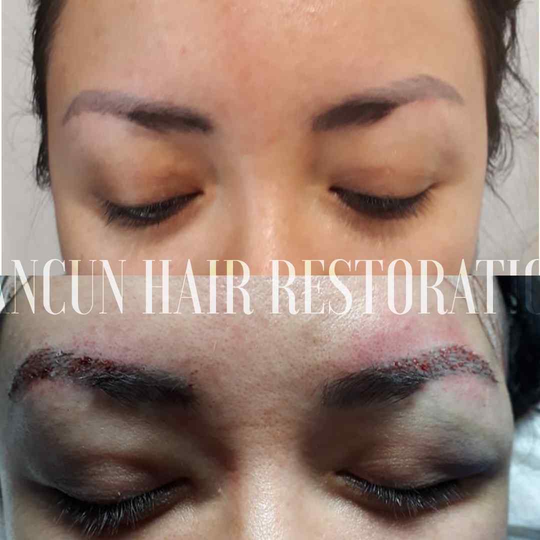 Results of an eyebrow hair transplant in a woman 1