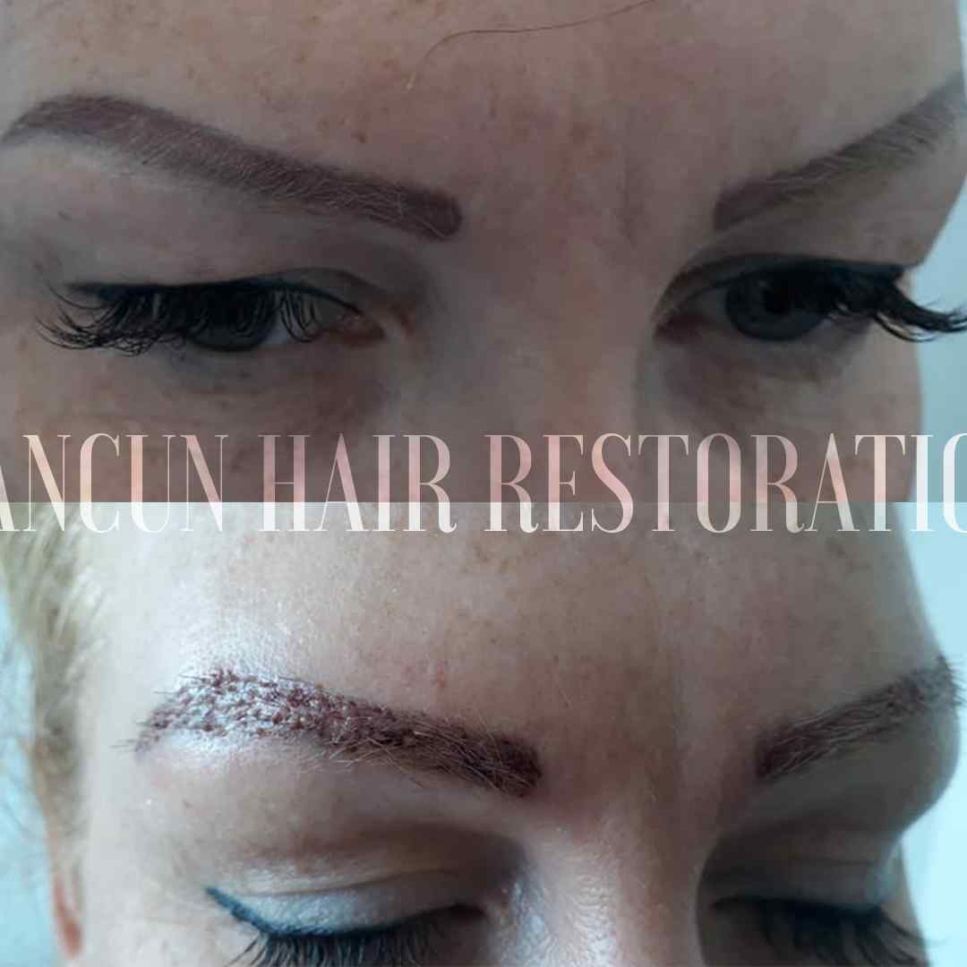 Results of an eyebrow hair transplant in a woman 2