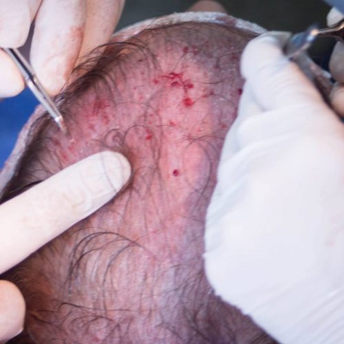 Placing of hair grafts during a FUT hair transplant