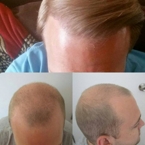 Results of a FUT hair transplant