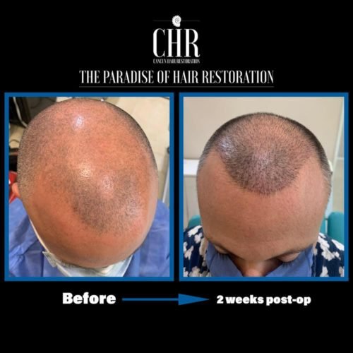 Before and after a FUE hair transplant