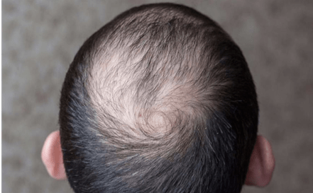Crown of the head with hair loss