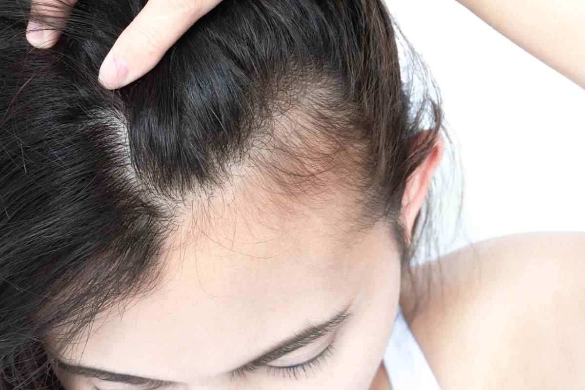 Types of hair loss
