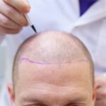 hair transplant in mexico