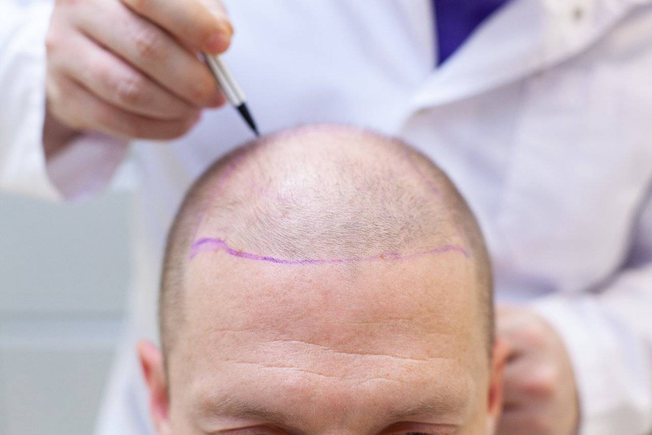 hair transplant in mexico