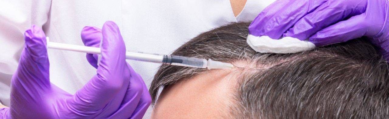 Doctor applying anesthesia for a hair transplant