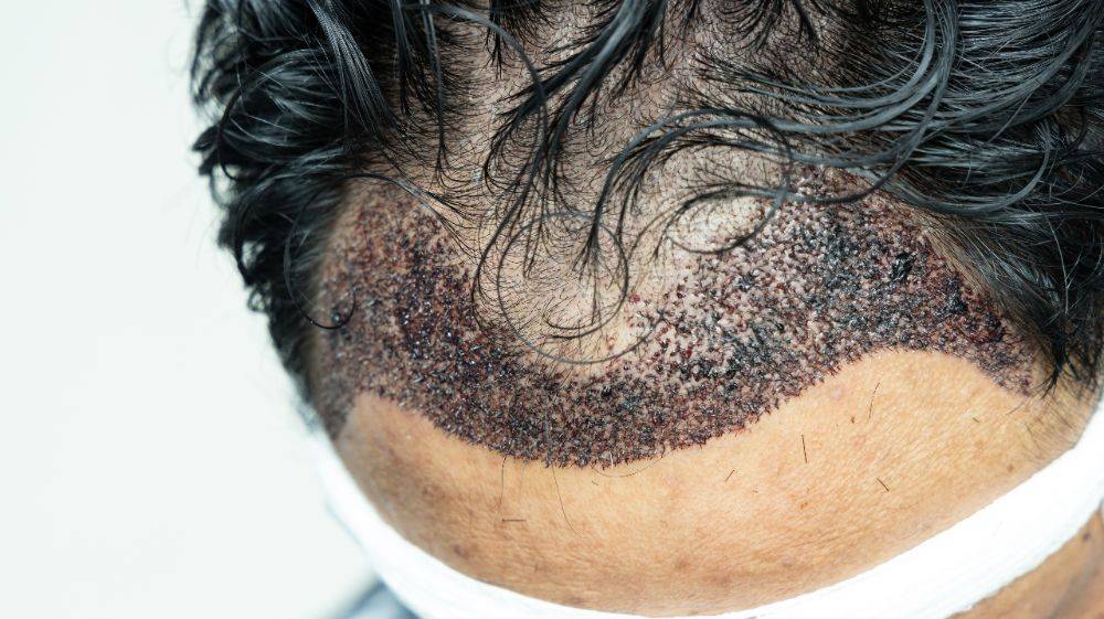 Fue hair transplant mexico