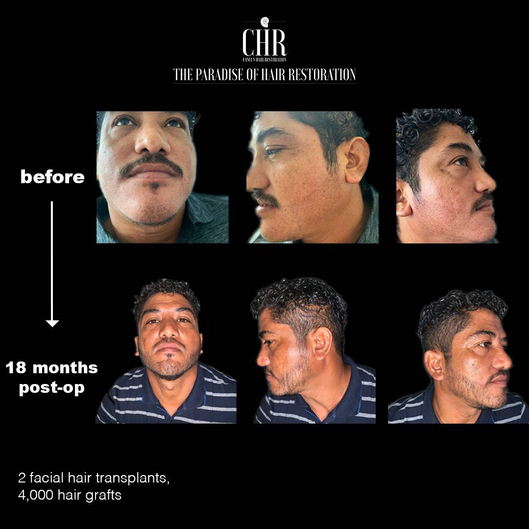 Before and after a facial hair transplant with FUT