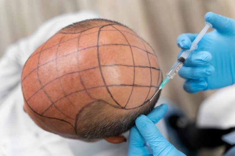 Doctor applying anesthesia to a patient for a hair transplant