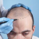 The hair transplant abroad in Mexico