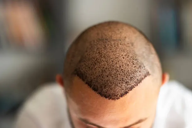 Close-up of a man’s forehead showing natural and dense results after a hair transplant in robotic hair transplant mexico, highlighting the quality of the procedure.