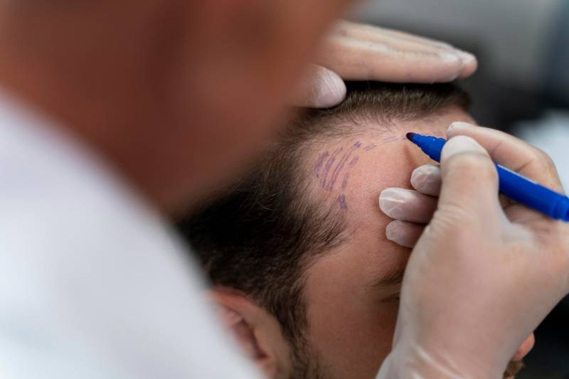 Doctor outlining head of patient to receive FUE hair transplant