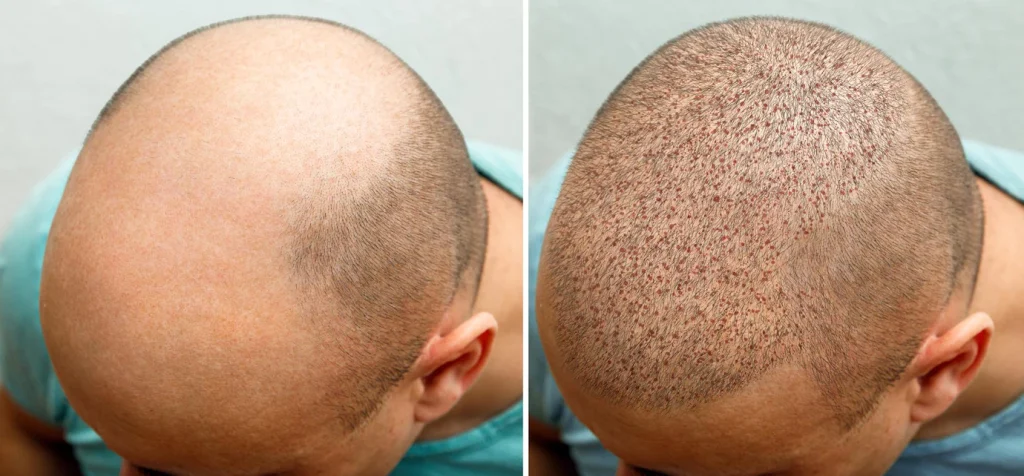 Antes y después del implante de cabello con ARTAS México