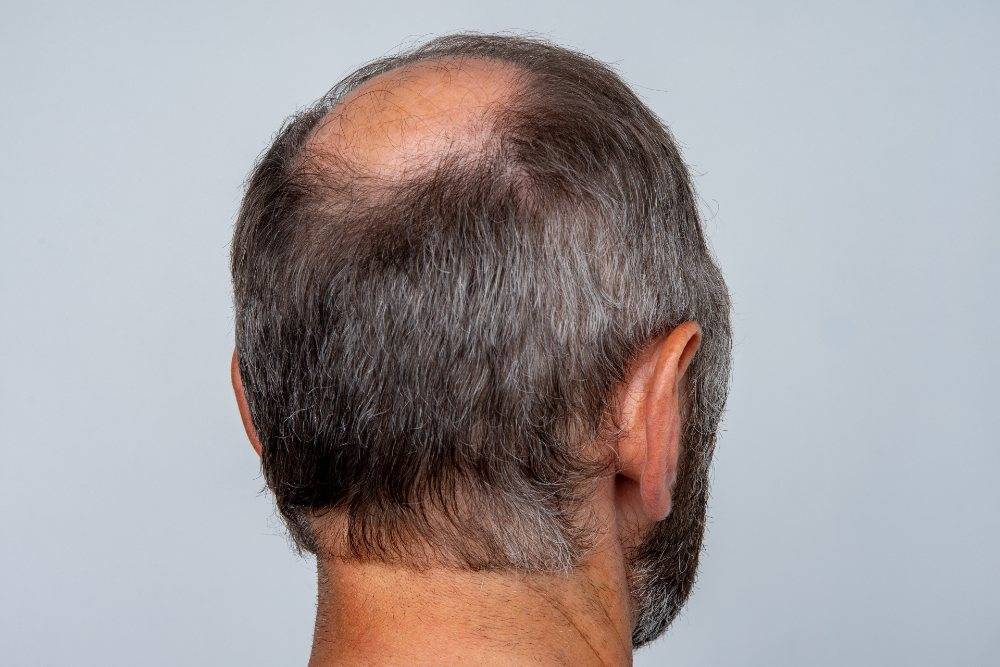 Un primer plano de una cabeza masculina medio calva, antes de un trasplante de cabello