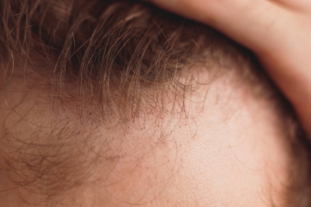 El hombre calvo está abriendo su frente vista de cerca antes de la cirugía de trasplante de cabello