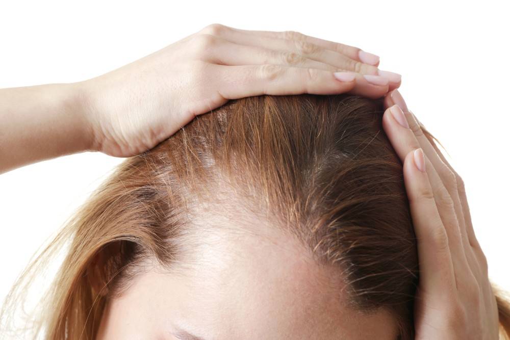 Mujer con problema de pérdida de cabello preparada para un Trasplante de cabello para mujeres
