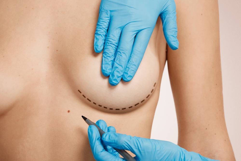 Doctor outlining a breast for plastic surgery in Mexico