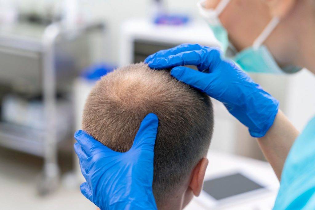 Doctor checking a patient before a DHI hair transplant