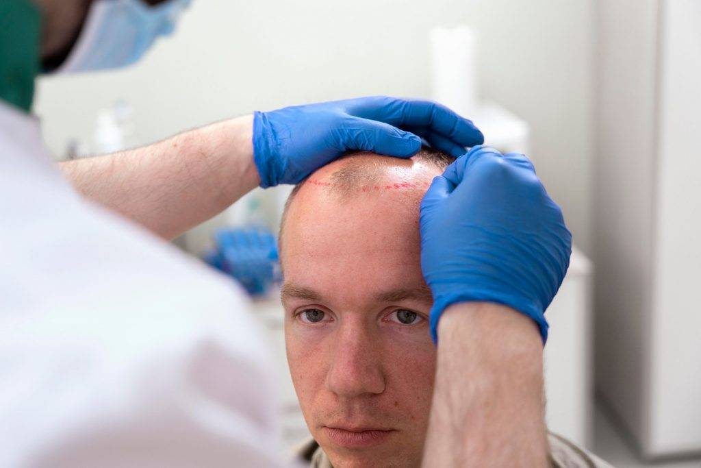 Doctor preparing a patient before a DHI hair transplant