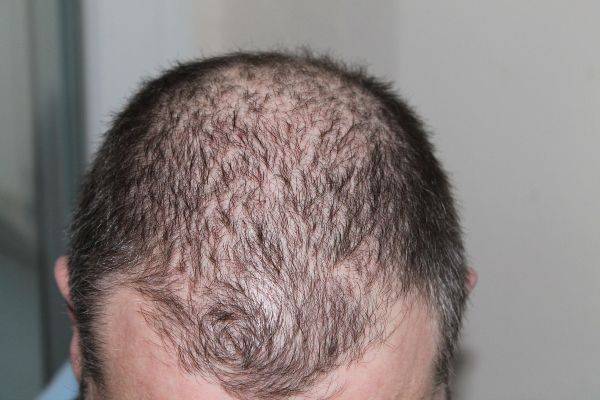 Crown hair transplant patient before surgery