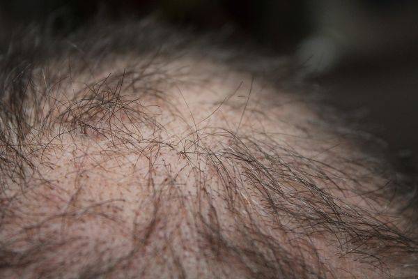 Crown hair transplant patient close up