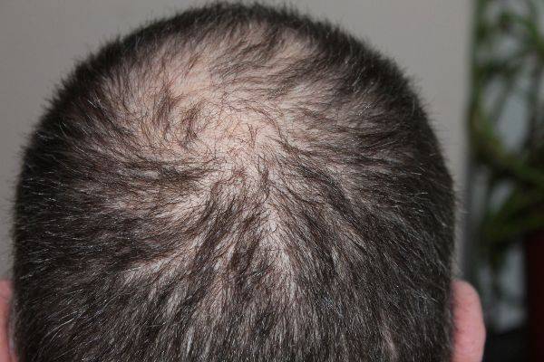 Crown hair transplant patient from the back