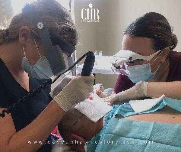 DHI hair transplant in Cancun Hair Restoration