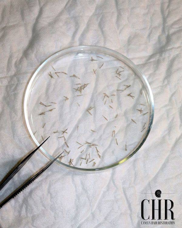 Hair implants on a magnifying glass