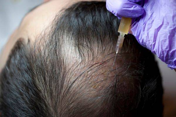 PRP hair treatment on crown of head
