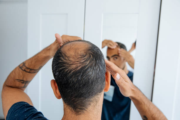 ARTAS hair transplants; acercamiento a la calvicie de un hombre