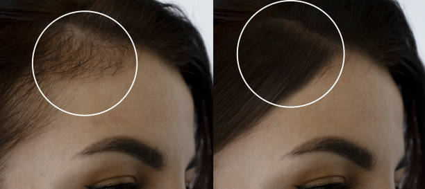 ARTAS hair transplants; cambio visual en el cuero cabelludo de una mujer
