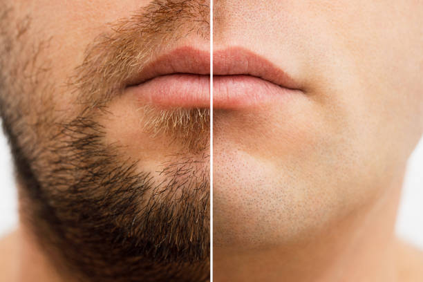 Facial hair transplant; antes y después de un trasplante de barba y bigote