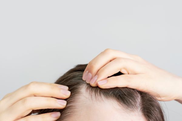 Hair transplant FUE; detail image of a woman showing her hair and a bald spot being a candidate for a hair transplant.