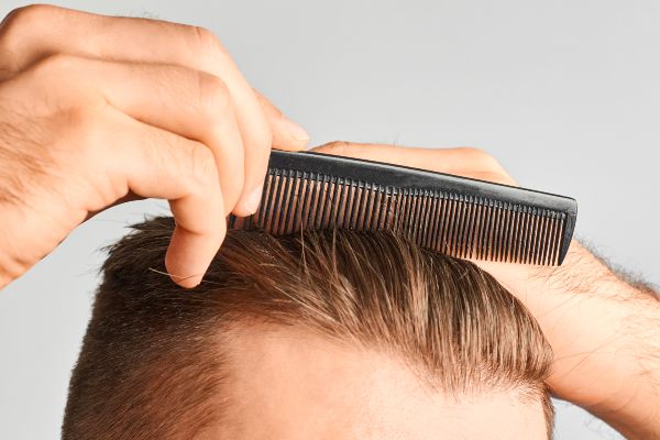 Hair transplant FUE; detail image of a man showing and combing his hair after a hair transplant.
