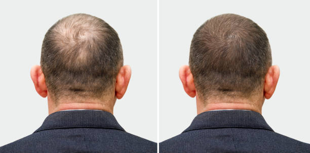 Injerto de cabello; antes y después de un injerto capilar en un hombre