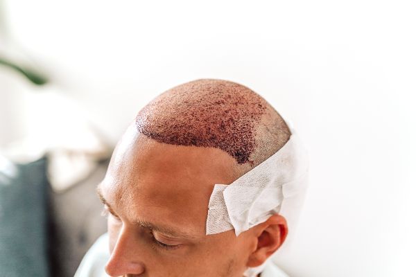Trasplante de cabello FUE; imagen de un hombre después de ser intervenido para un trasplante con técnica FUE para el crecimiento del cabello.
