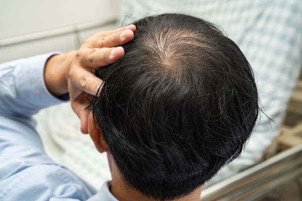 Older person having a Best FUE hair transplant México Men wishing a best fue hair transplant