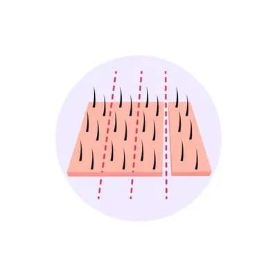 Drawing illustrating the redesigned hairline using the FUE method, showcasing the benefits of hair transplant for achieving natural results.