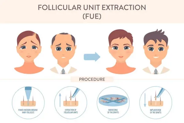 Illustration showing a woman and a man before and after the hair graft process, emphasizing the remarkable impact of hair graft procedures.