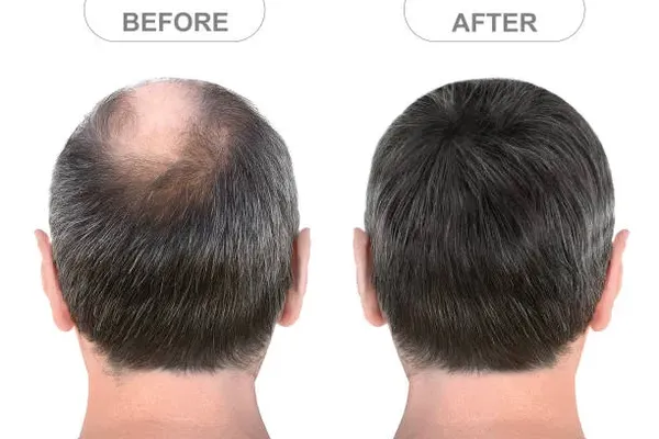 Image showing the transformation of a bald man to one with a full head of hair, highlighting the excellent results and affordable hair transplant cost Mexico.