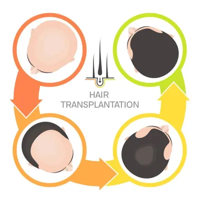 Illustration of the hair transplant process on a man's head, highlighting the technique used and relating to the cost of how much is a hair transplant.