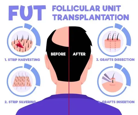 Before and after image showing a man's head transformation, highlighting that is hair transplant permanent for long-term hair restoration results.