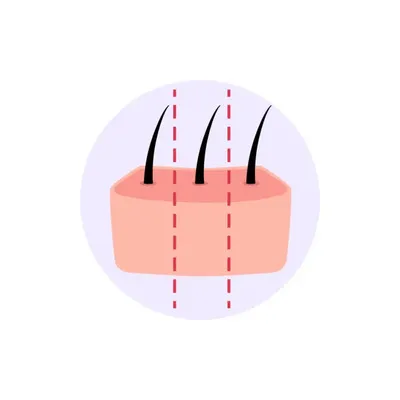 Detailed illustration of extracted hairs for transplant, highlighting the benefits of hair transplant in aesthetic procedures.