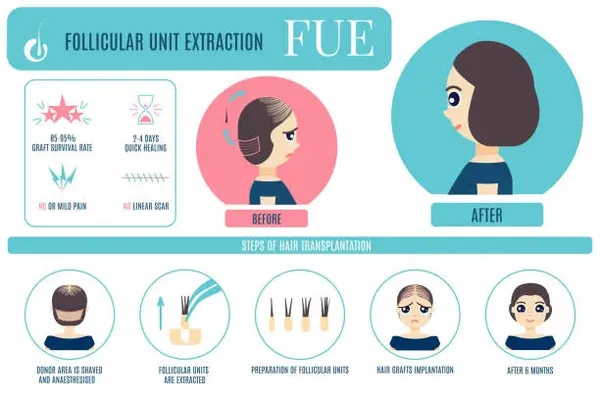 Illustration of a woman during the hair graft process, highlighting the precision and care involved in hair restoration techniques.