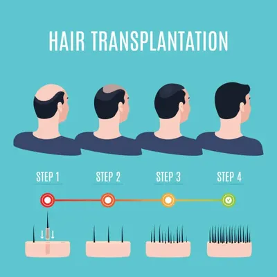 Illustration of the hair transplant process, from extraction to implantation, while exploring the question how much is a hair transplant.