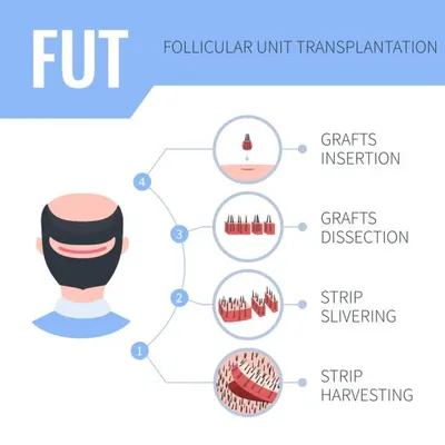Drawing of a man’s head explaining the FUE method, perfect for understanding the benefits of hair transplant in this procedure.