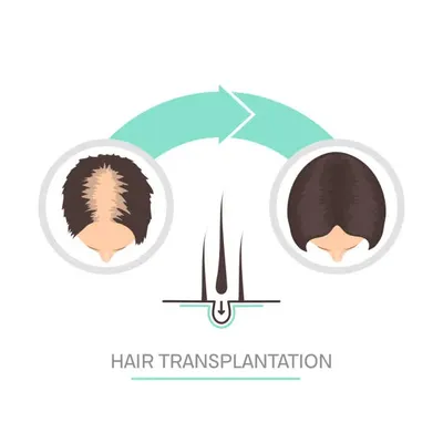 Illustration depicting a woman before and after a hair graft procedure, demonstrating the transformative effects of hair restoration.